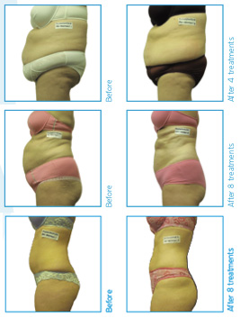 ilipo-before-after.jpg